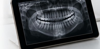 Dental OPG panoramic x-ray on a tablet